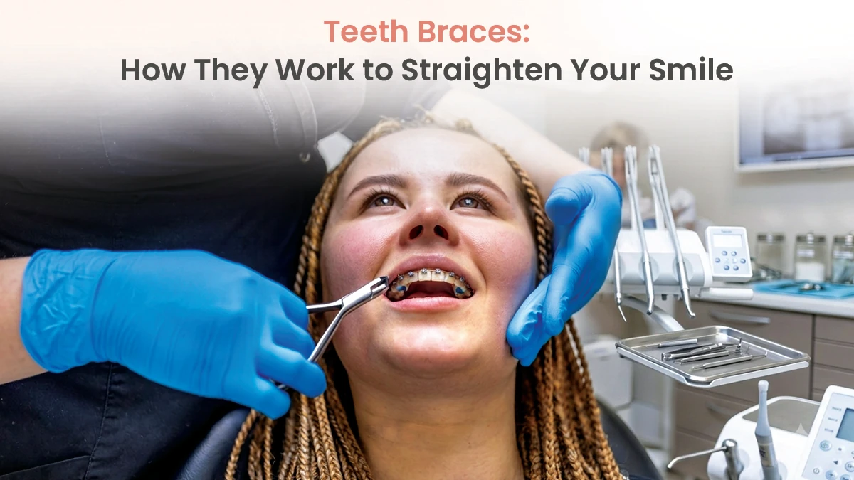 Teeth Braces: How They Work to Straighten Your Smile?